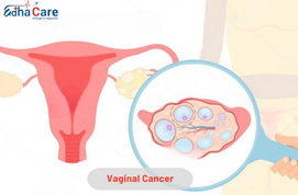 Cancer vaginal | Traitement du cancer vaginal | EdhaCare