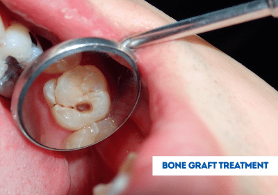 bone graft treatment in india