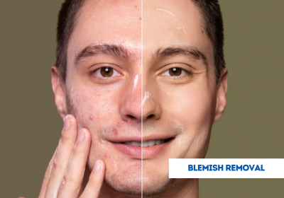 blemish removal in india