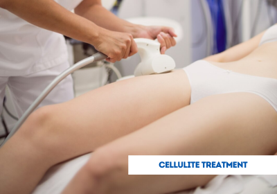 cellulite treatment in india