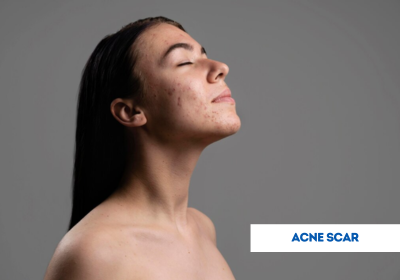 acne scar treatment in india
