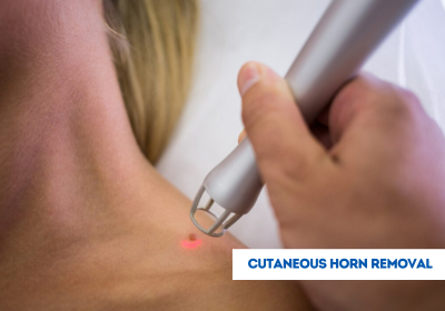 Cutaneous Horn Removal