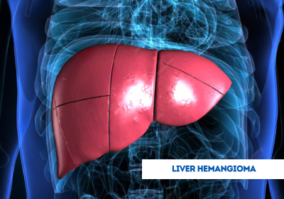 liver hemangioma treatment in india