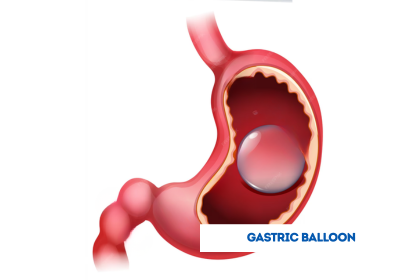 gastric balloon treatment in india