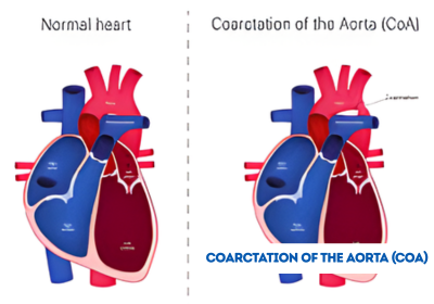coarctation of the aorta surgery in india