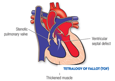 tetralogy of fallot treatment in india