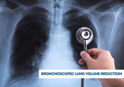 bronchoscopic lung volume reduction treatment in india