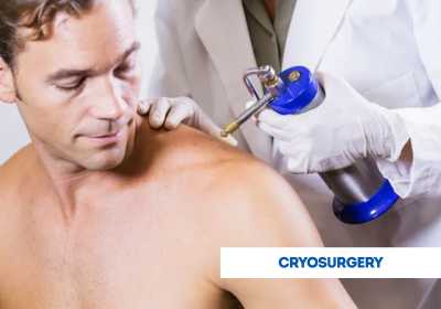 cryosurgery surgery in india