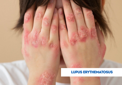 lupus erythematosus treatment in india